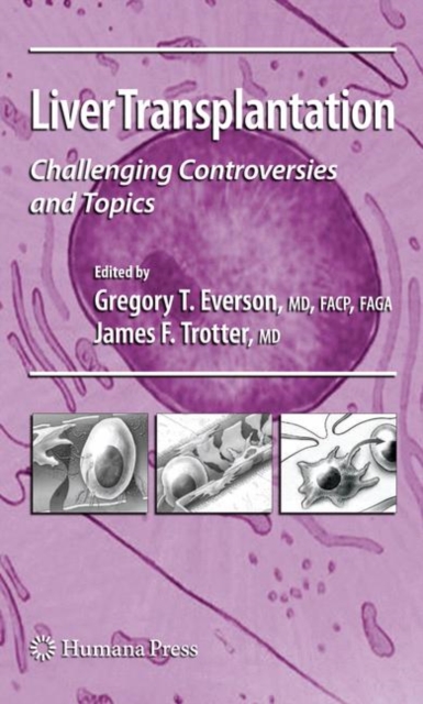 Liver Transplantation : Challenging Controversies and Topics, Paperback / softback Book