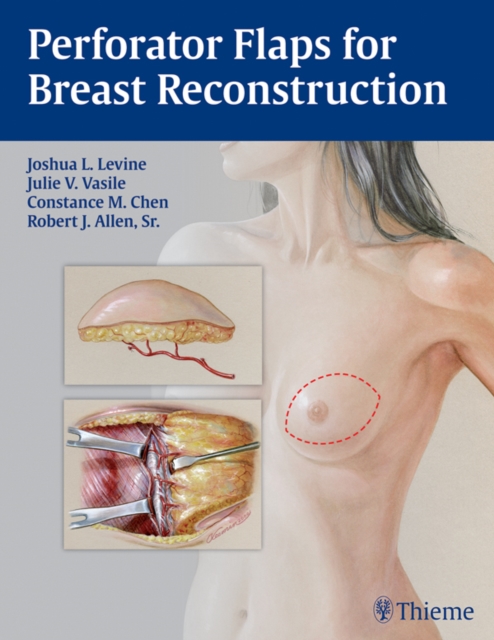 Perforator Flaps for Breast Reconstruction, EPUB eBook