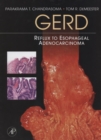 GERD : Reflux to Esophageal Adenocarcinoma - eBook
