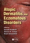 Atopic Dermatitis and Eczematous Disorders - eBook