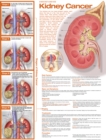 Understanding Kidney Cancer Anatomical Chart - Book