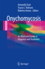 Onychomycosis : An Illustrated Guide to Diagnosis and Treatment - eBook