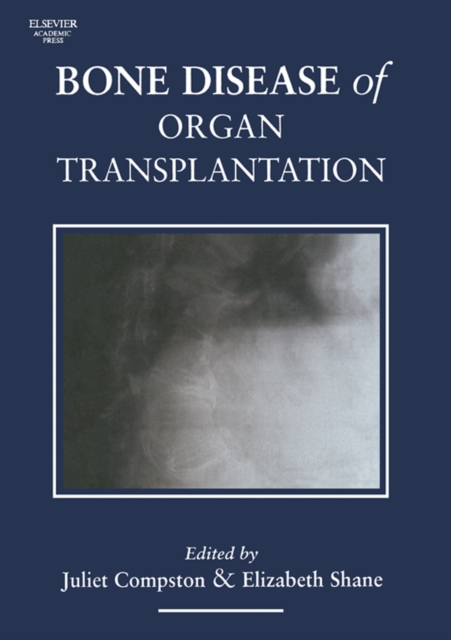 Bone Disease of Organ Transplantation, EPUB eBook