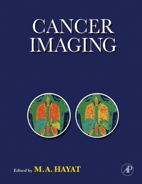 Cancer Imaging : Lung and Breast Carcinomas, PDF eBook
