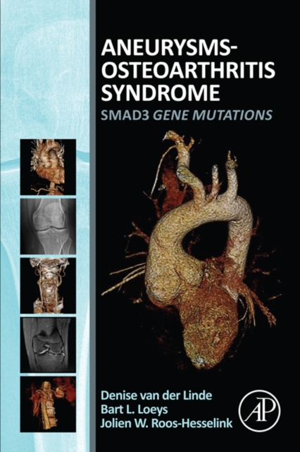 Aneurysms-Osteoarthritis Syndrome : SMAD3 Gene Mutations, EPUB eBook