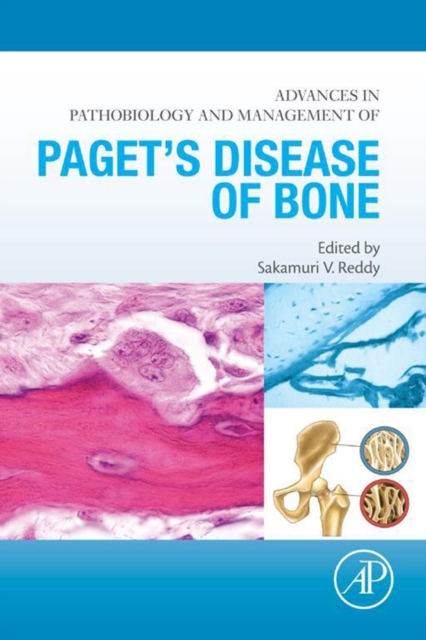 Advances in Pathobiology and Management of Paget's Disease of Bone, EPUB eBook