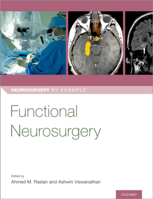 Functional Neurosurgery, EPUB eBook
