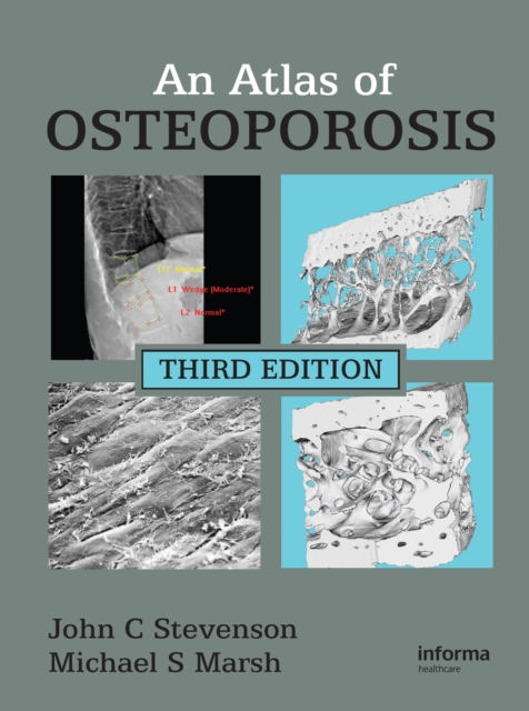An Atlas of Osteoporosis, PDF eBook