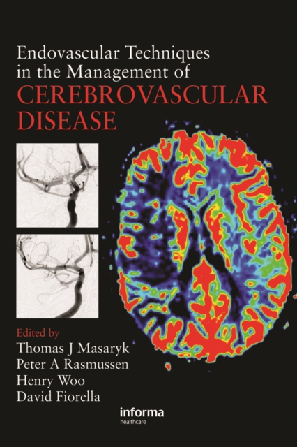 Endovascular Techniques in the Management of Cerebrovascular Disease, PDF eBook