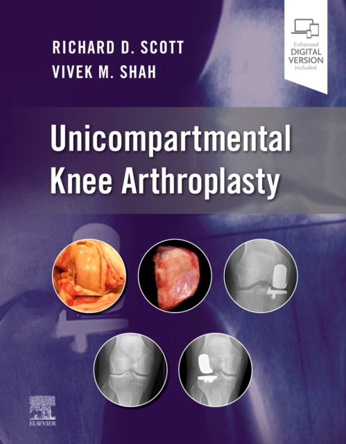 Unicompartmental Knee Arthroplasty, Hardback Book