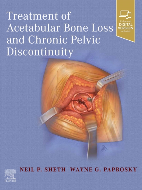 Treatment of Acetabular Bone Loss and Chronic Pelvic Discontinuity, EPUB eBook