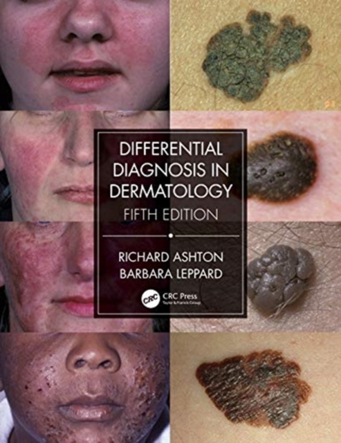 Differential Diagnosis in Dermatology, Paperback / softback Book