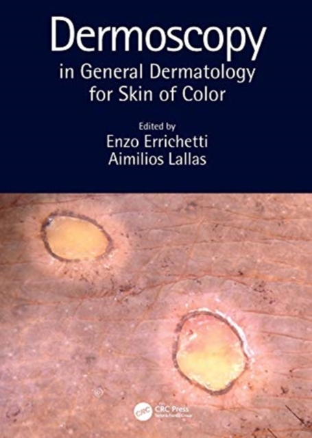 Dermoscopy in General Dermatology for Skin of Color, Hardback Book
