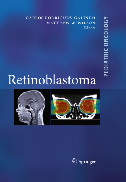 Retinoblastoma, PDF eBook