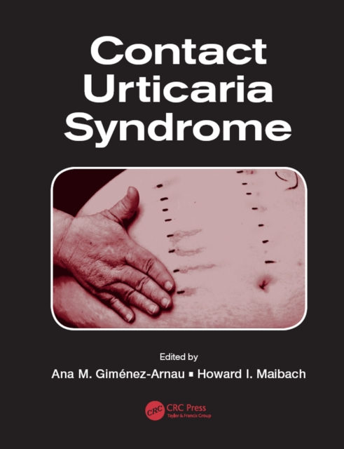 Contact Urticaria Syndrome, EPUB eBook