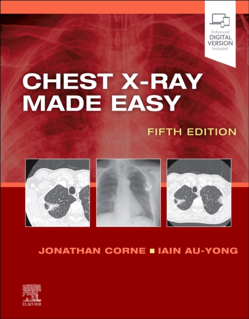 Chest X-Ray Made Easy, Paperback / softback Book