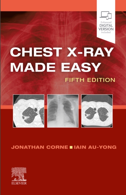 Chest X-Ray Made Easy E-Book : Chest X-Ray Made Easy E-Book, EPUB eBook