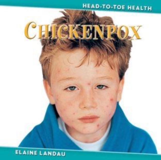 Chickenpox, PDF eBook