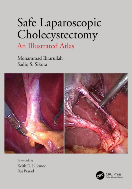 Safe Laparoscopic Cholecystectomy : An Illustrated Atlas, EPUB eBook