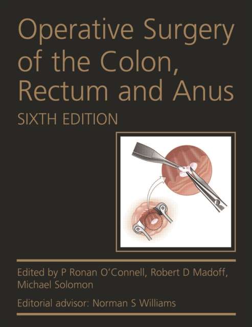 Operative Surgery of the Colon, Rectum and Anus, EPUB eBook