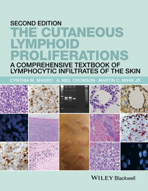 The Cutaneous Lymphoid Proliferations : A Comprehensive Textbook of Lymphocytic Infiltrates of the Skin, EPUB eBook
