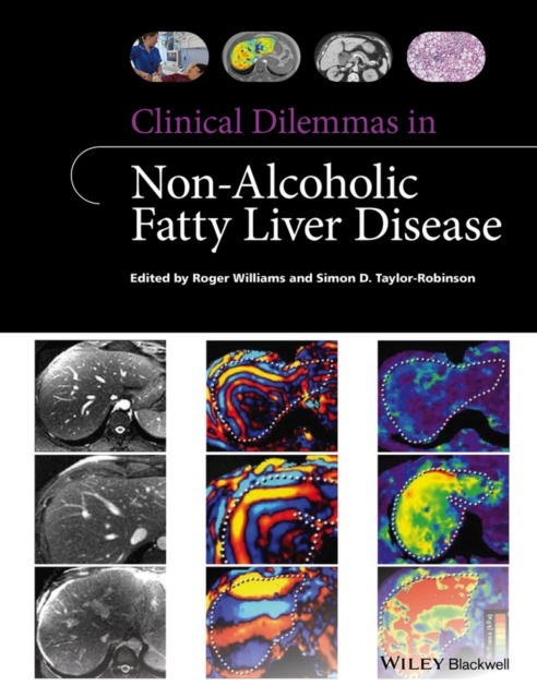 Clinical Dilemmas in Non-Alcoholic Fatty Liver Disease, PDF eBook