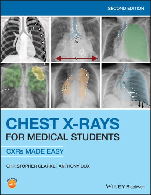 Chest X-Rays for Medical Students : CXRs Made Easy, Paperback / softback Book