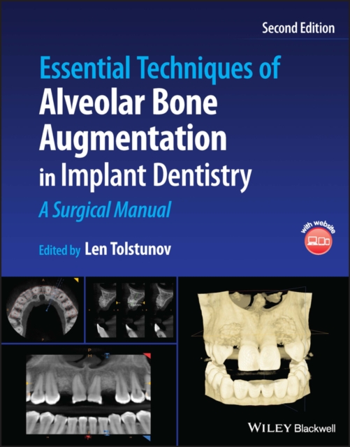Essential Techniques of Alveolar Bone Augmentation in Implant Dentistry : A Surgical Manual, Hardback Book