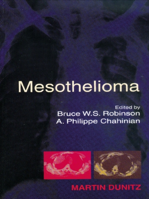 Mesothelioma, EPUB eBook