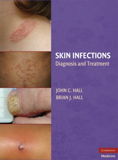 Skin Infections : Diagnosis and Treatment, EPUB eBook