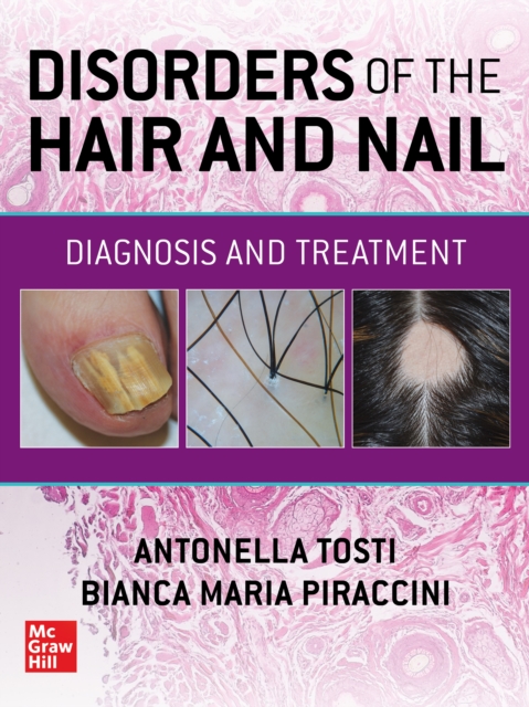 Disorders of the Hair and Nail: Diagnosis and Treatment, PDF eBook