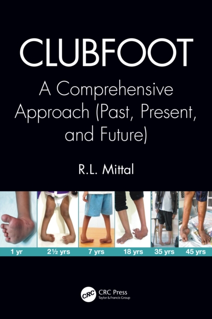 Clubfoot : A Comprehensive Approach (Past, Present, and Future), PDF eBook