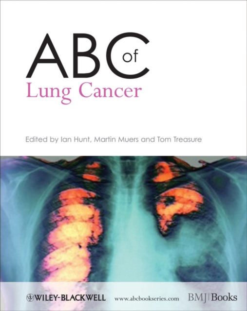 ABC of Lung Cancer, PDF eBook
