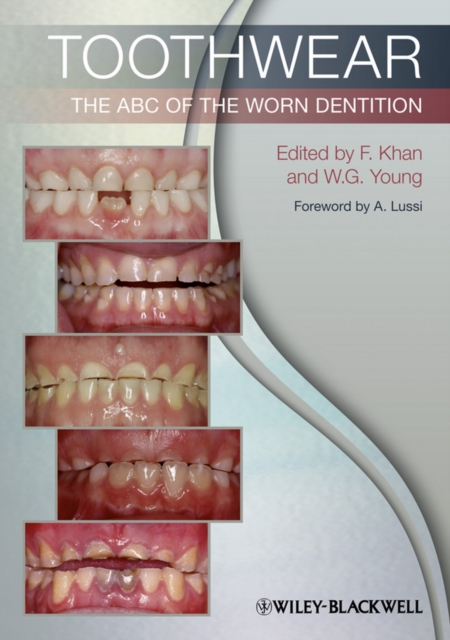Toothwear : The ABC of the Worn Dentition, PDF eBook