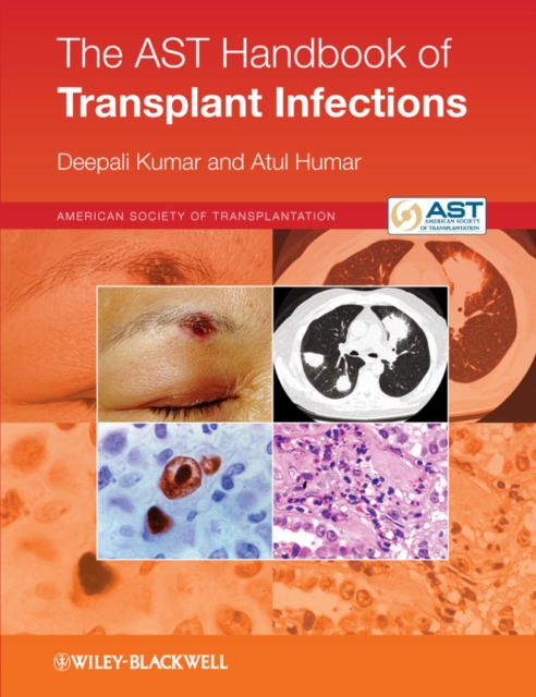 The AST Handbook of Transplant Infections, EPUB eBook