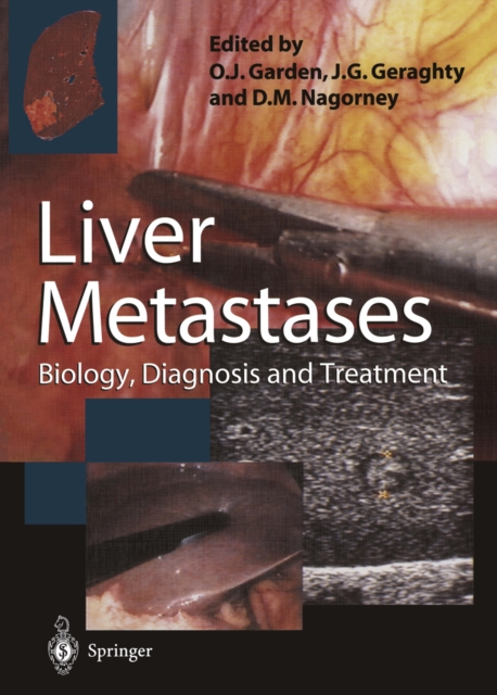 Liver Metastases : Biology, Diagnosis and Treatment, PDF eBook