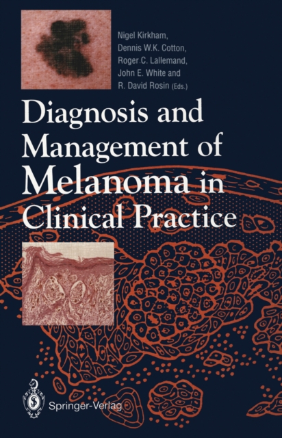 Diagnosis and Management of Melanoma in Clinical Practice, PDF eBook