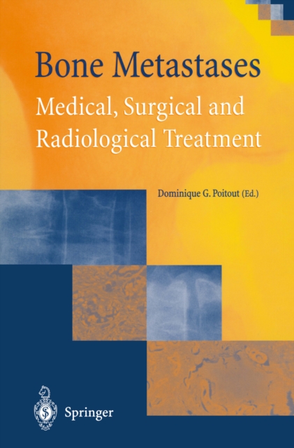 Bone Metastases : Medical, Surgical and Radiological Treatment, PDF eBook