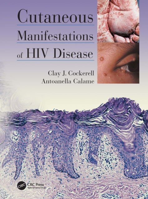 Cutaneous Manifestations of HIV Disease, EPUB eBook