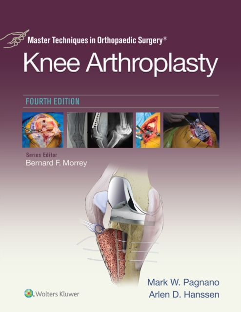 Master Techniques in Orthopedic Surgery: Knee Arthroplasty, EPUB eBook