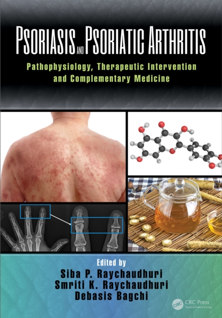 Psoriasis and Psoriatic Arthritis : Pathophysiology, Therapeutic Intervention, and Complementary Medicine, PDF eBook