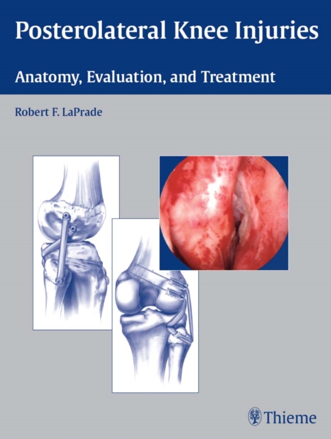 Posterolateral Knee Injuries : Anatomy, Evaluation, and Treatment, EPUB eBook