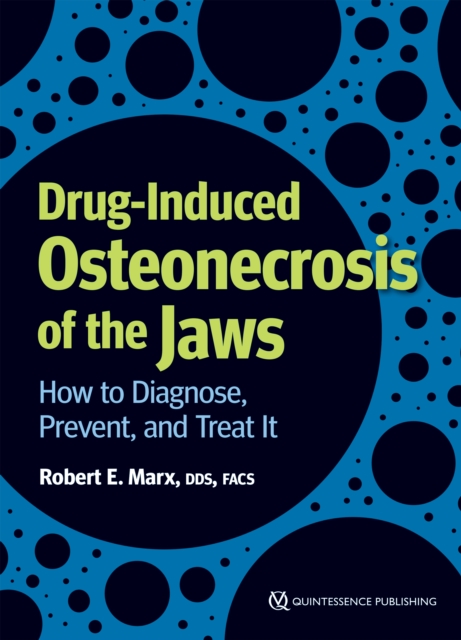 Drug-Induced Osteonecrosis of the Jaws : How to Diagnose, Prevent, and Treat It, EPUB eBook