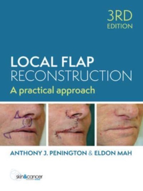 Local Flap Reconstruction, Hardback Book