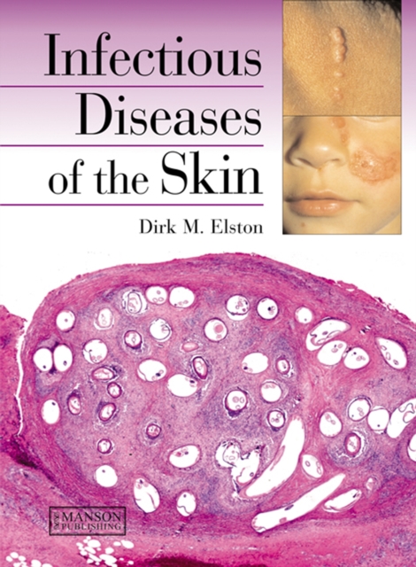 Infectious Diseases of the Skin, PDF eBook