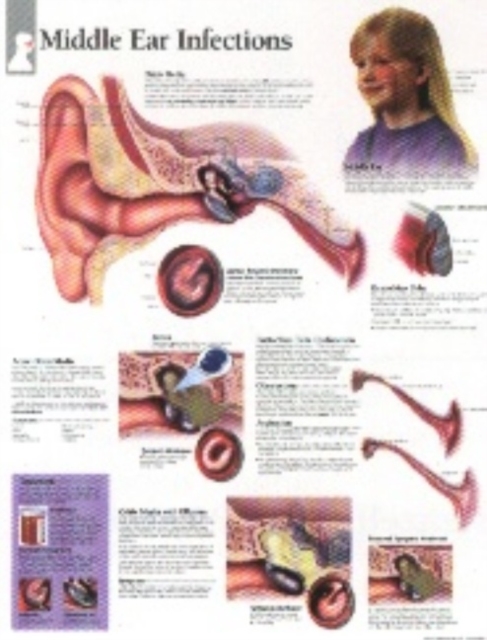 Middle Ear Infections Laminated Poster, Poster Book