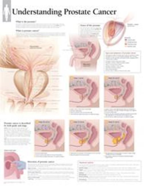 Understanding Prostate Cancer Laminated Poster, Wallchart Book