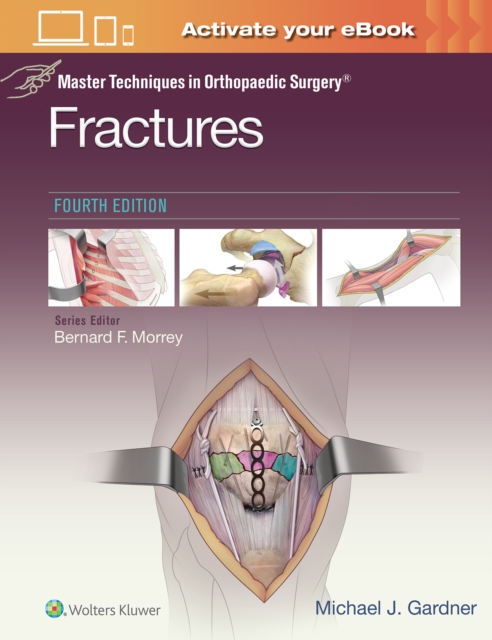 Master Techniques in Orthopaedic Surgery: Fractures, Hardback Book