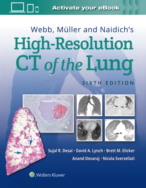 Webb, Muller and Naidich's High-Resolution CT of the Lung, Hardback Book