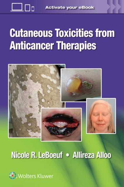Cutaneous Toxicities from Anticancer Therapies, Paperback / softback Book